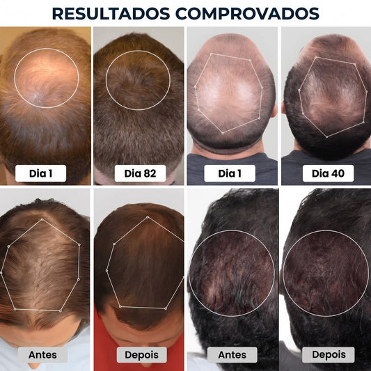 Tecnologia LED para Crescimento Capilar